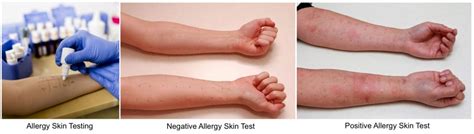 scratch test negative|allergy skin test negative.